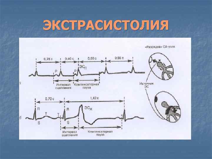 ЭКСТРАСИСТОЛИЯ 