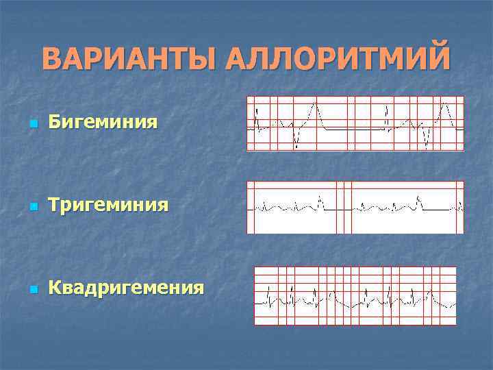 ВАРИАНТЫ АЛЛОРИТМИЙ n Бигеминия n Тригеминия n Квадригемения 