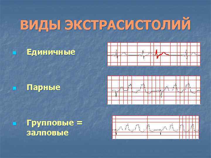 ВИДЫ ЭКСТРАСИСТОЛИЙ n Единичные n Парные n Групповые = залповые 