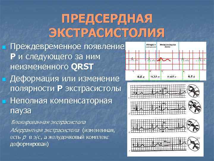 ПРЕДСЕРДНАЯ ЭКСТРАСИСТОЛИЯ n n n Преждевременное появление Р и следующего за ним неизмененного QRSТ