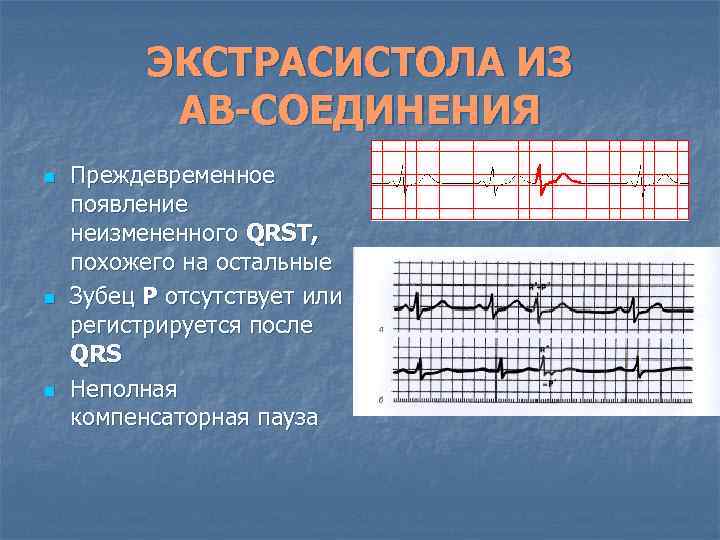 ЭКСТРАСИСТОЛА ИЗ АВ-СОЕДИНЕНИЯ n n n Преждевременное появление неизмененного QRSТ, похожего на остальные Зубец