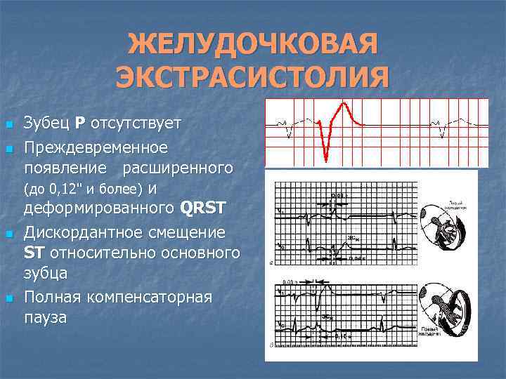 ЖЕЛУДОЧКОВАЯ ЭКСТРАСИСТОЛИЯ n n Зубец Р отсутствует Преждевременное появление расширенного (до 0, 12