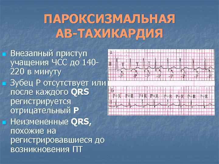 ПАРОКСИЗМАЛЬНАЯ АВ-ТАХИКАРДИЯ n n n Внезапный приступ учащения ЧСС до 140220 в минуту Зубец