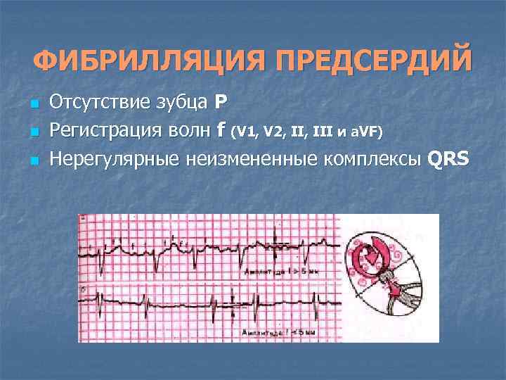 ФИБРИЛЛЯЦИЯ ПРЕДСЕРДИЙ n n n Отсутствие зубца Р Регистрация волн f (V 1, V