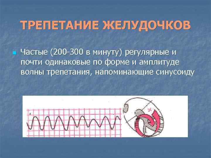 ТРЕПЕТАНИЕ ЖЕЛУДОЧКОВ n Частые (200 -300 в минуту) регулярные и почти одинаковые по форме