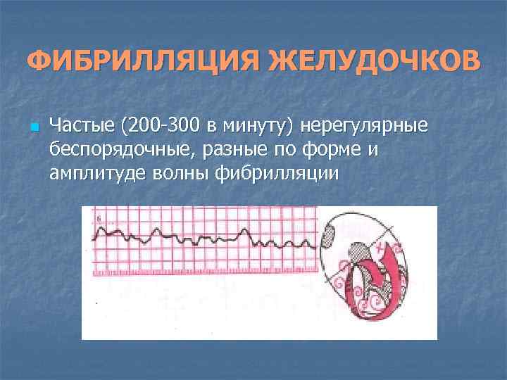 ФИБРИЛЛЯЦИЯ ЖЕЛУДОЧКОВ n Частые (200 -300 в минуту) нерегулярные беспорядочные, разные по форме и