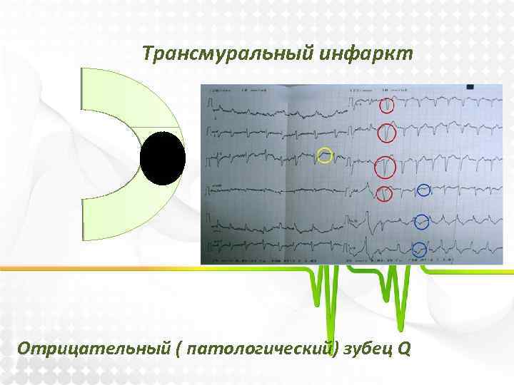 Трансмуральный инфаркт. Трансмуральный им. Для трансмурального инфаркта миокарда характерно. Трансмуральный q негативный.