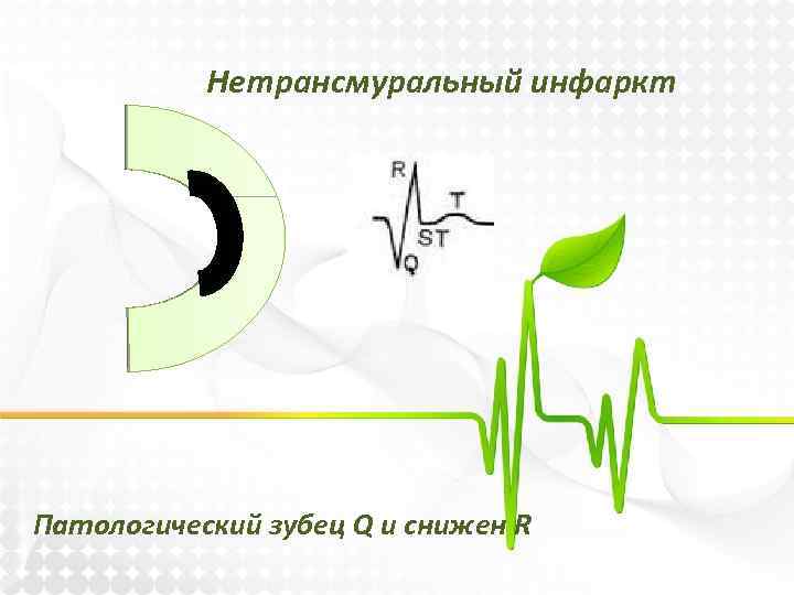 Нетрансмуральный инфаркт Патологический зубец Q и снижен R 