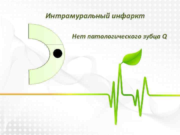 Интрамуральный инфаркт Нет патологического зубца Q 