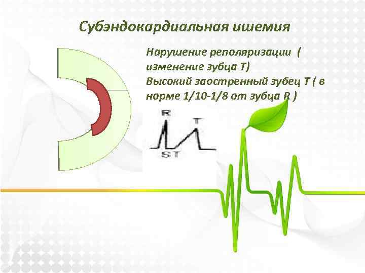 Субэндокардиальная ишемия на экг фото