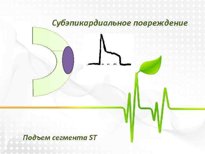 Субэпикардиальное повреждение Подъем сегмента ST 