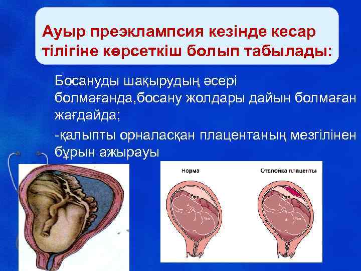 Ауыр преэклампсия кезінде кесар тілігіне көрсеткіш болып табылады: Босануды шақырудың әсері болмағанда, босану жолдары