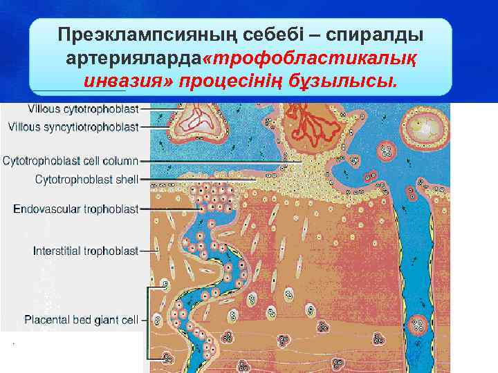 Преэклампсияның себебі – спиралды артерияларда «трофобластикалық инвазия» процесінің бұзылысы. 