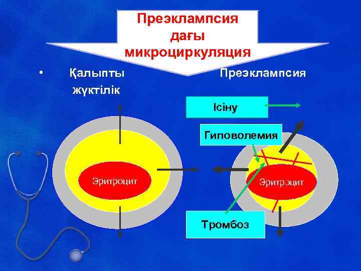 Преэклампсия дағы микроциркуляция • Қалыпты жүктілік Преэклампсия Ісіну Гиповолемия Эритроцит Тромбоз 