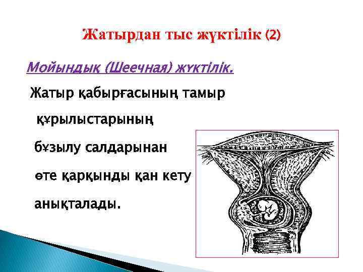 Жатырдан тыс жүктілік (2) Мойындық (Шеечная) жүктілік. Жатыр қабырғасының тамыр құрылыстарының бұзылу салдарынан өте