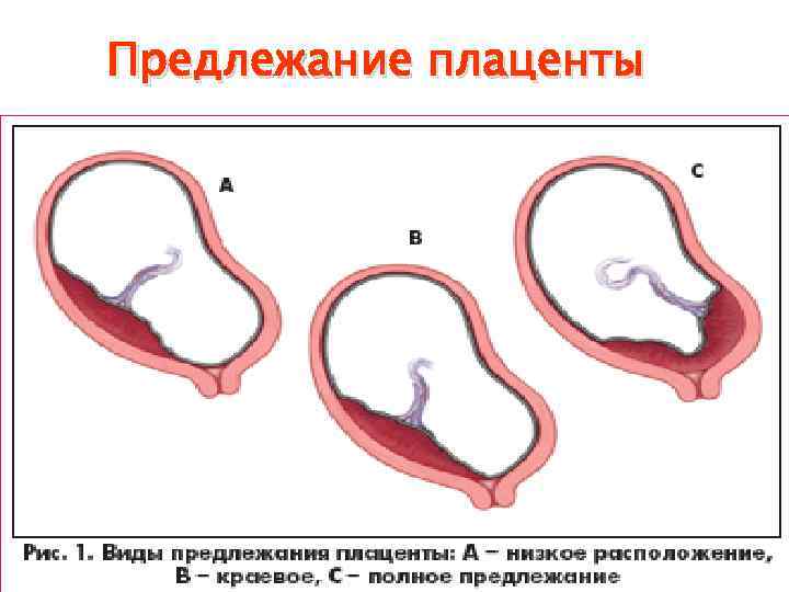 Патологическое прикрепление плаценты предлежание и врастание плаценты. Краевое и центральное предлежание плаценты. Центральное расположение плаценты.