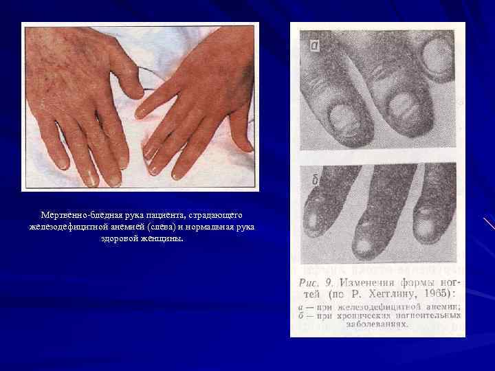 Мертвенно-бледная рука пациента, страдающего железодефицитной анемией (слева) и нормальная рука здоровой женщины. 