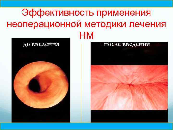Ч Эффективность применения неоперационной методики лечения НМ до введения после введения Ч 