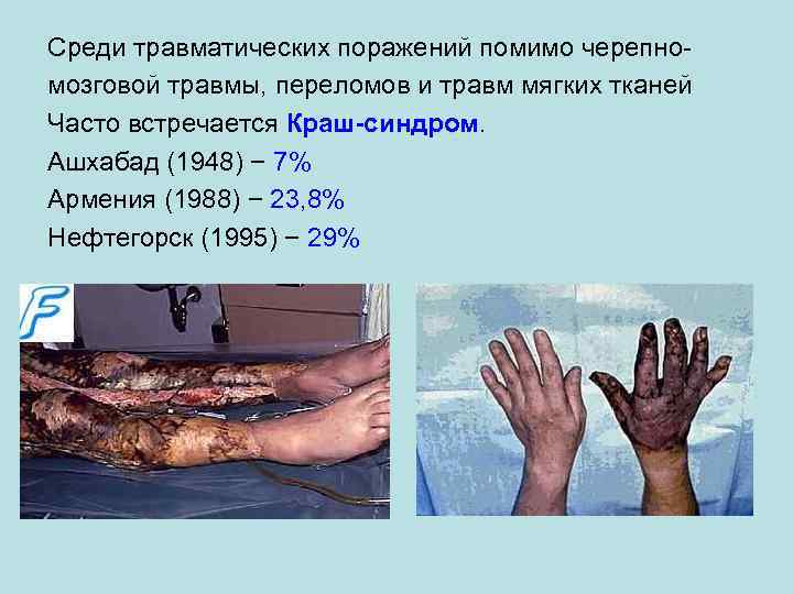 Среди травматических поражений помимо черепномозговой травмы, переломов и травм мягких тканей Часто встречается Краш-синдром.