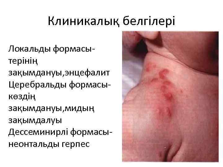 Клиникалық белгілері Локальды формасытерінің зақымдануы, энцефалит Церебральды формасыкөздің зақымдануы, мидың зақымдалуы Дессеминирлі формасынеонтальды герпес
