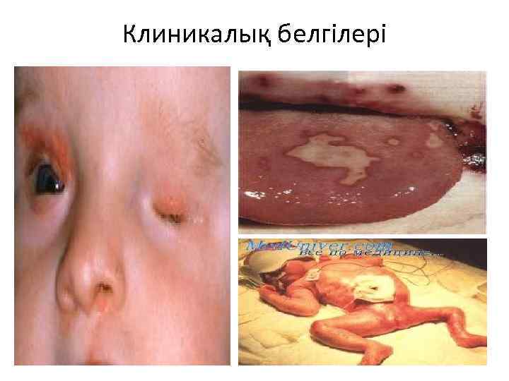 Клиникалық белгілері 