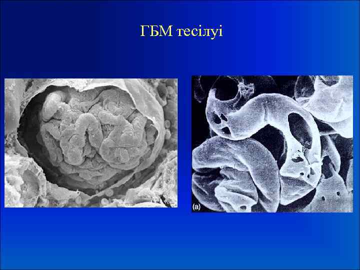 ГБМ тесілуі 