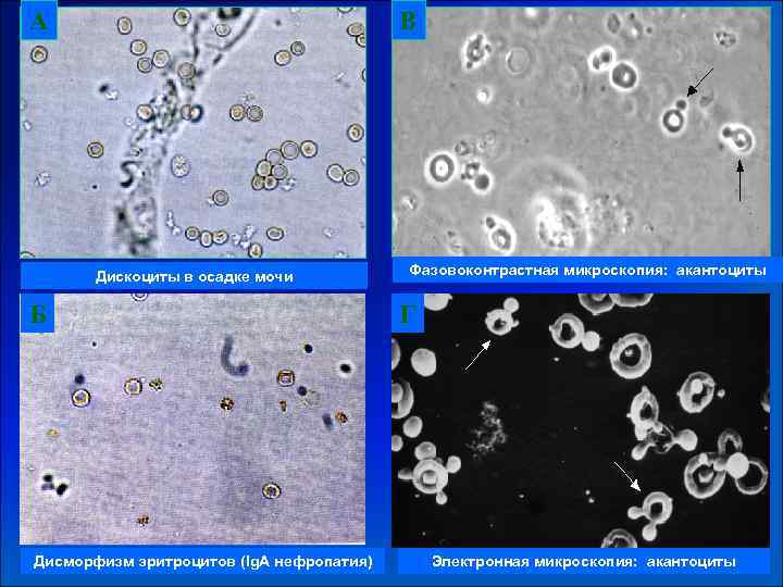А В Дискоциты в осадке мочи Б Дисморфизм эритроцитов (Ig. А нефропатия) Фазовоконтрастная микроскопия: