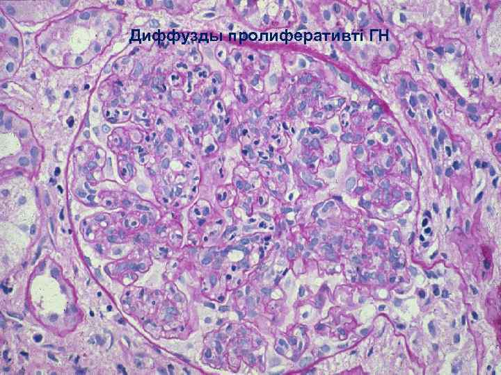 Диффузды пролиферативті ГН 