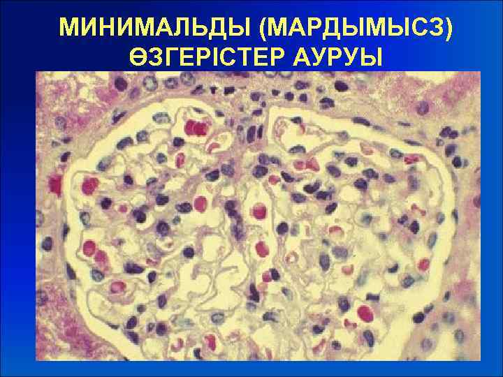 МИНИМАЛЬДЫ (МАРДЫМЫСЗ) ӨЗГЕРІСТЕР АУРУЫ 