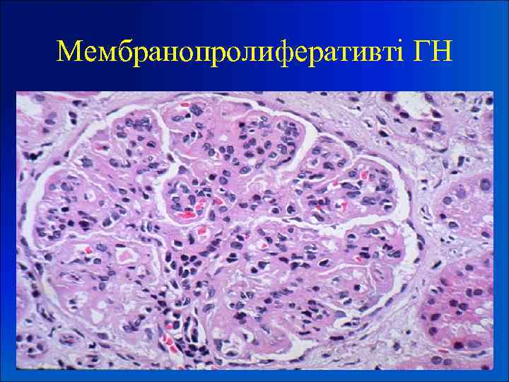 Мембранопролиферативті ГН 