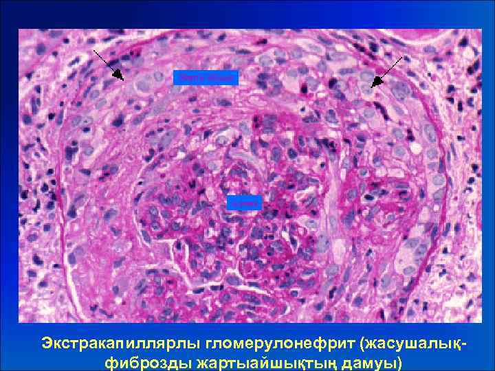 Жарты айшық шумақ Экстракапиллярлы гломерулонефрит (жасушалықфиброзды жартыайшықтың дамуы) 