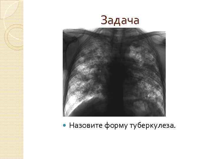 Задача Назовите форму туберкулеза. 