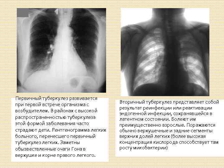 Клинический случай туберкулез. Формы первичного туберкулеза. Первичные и вторичные формы туберкулеза. Формы заболевания туберкулеза.