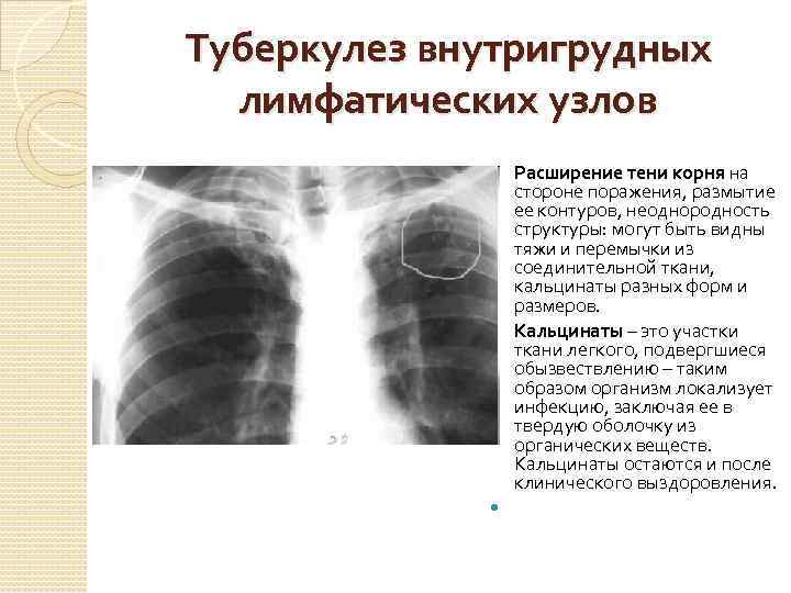 Легкие увеличен узел. Туберкулез лимфоузлов легких рентген. Рентген инфильтративный туберкулез внутригрудных лимфоузлов. Туберкулез внутригрудных лимфатических узлов кт. Обызвествление внутригрудных лимфоузлов рентген.