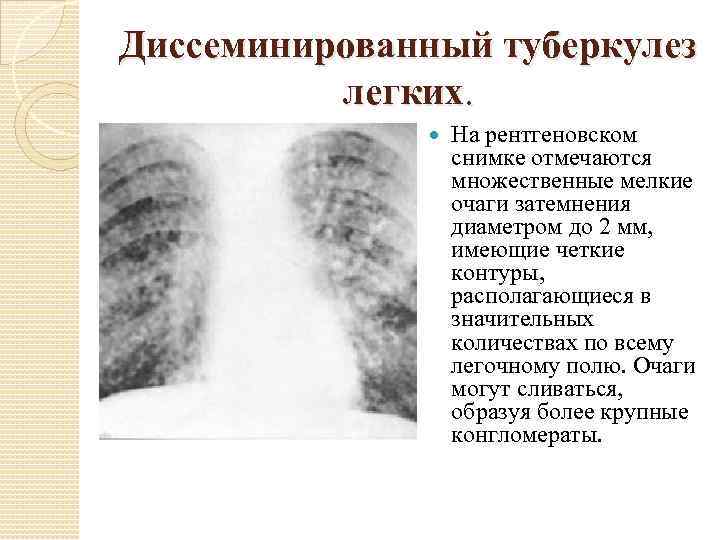 Диссеминированный туберкулез фаза инфильтрации. Подострый диссеминированный туберкулез рентген. Милиарный диссеминированный туберкулез рентген. Хронический диссеминированный туберкулез рентген. Диссеминированный туберкулез легких снимки рентген.