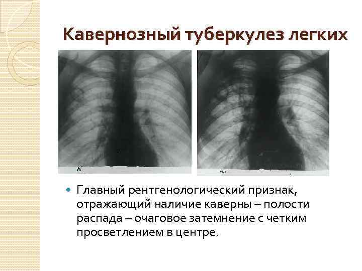 Цирротический туберкулез легких презентация