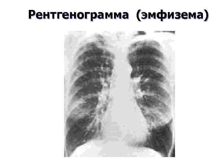 Рентгенограмма (эмфизема) 