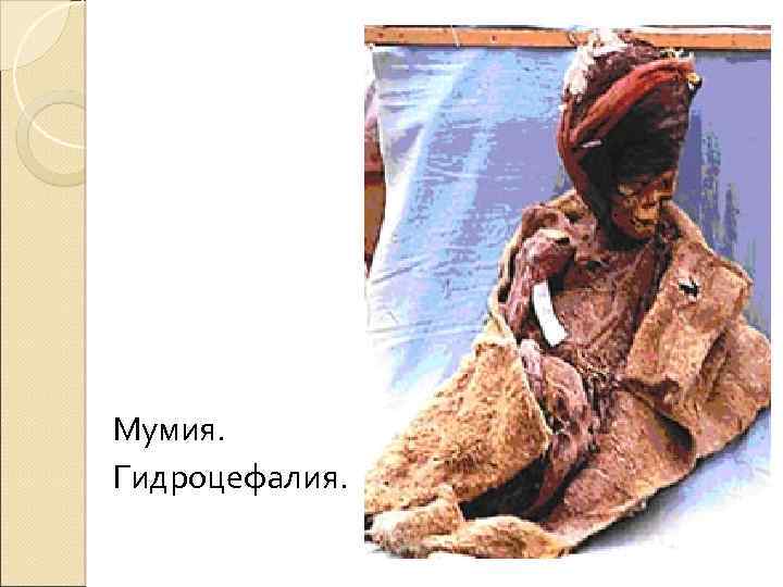 Мумия. Гидроцефалия. 