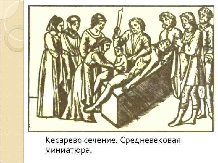 Кесарево сечение. Средневековая миниатюра. 