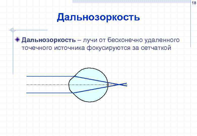 18 Дальнозоркость – лучи от бесконечно удаленного точечного источника фокусируются за сетчаткой 