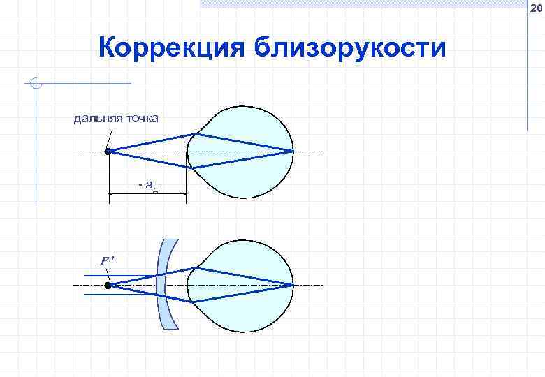 Дальше точки. Коррекция близорукости. Схема коррекции миопии. Коррекция близорукости проводится. На дальней точке.