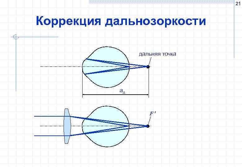 21 Коррекция дальнозоркости дальняя точка aд F 