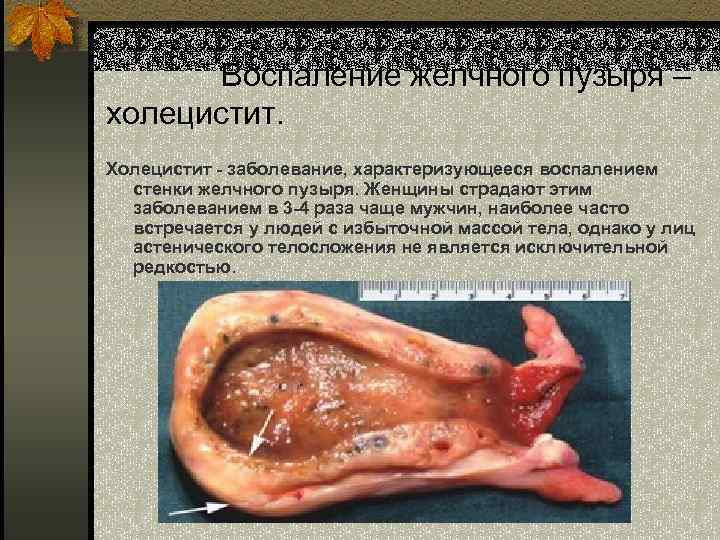 Воспаление желчного пузыря – холецистит. Холецистит - заболевание, характеризующееся воспалением стенки желчного пузыря. Женщины