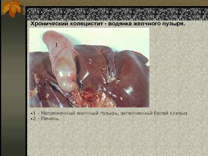 Хронический холецистит - водянка желчного пузыря. • 1 - Напряженный желчный пузырь, заполненный белой