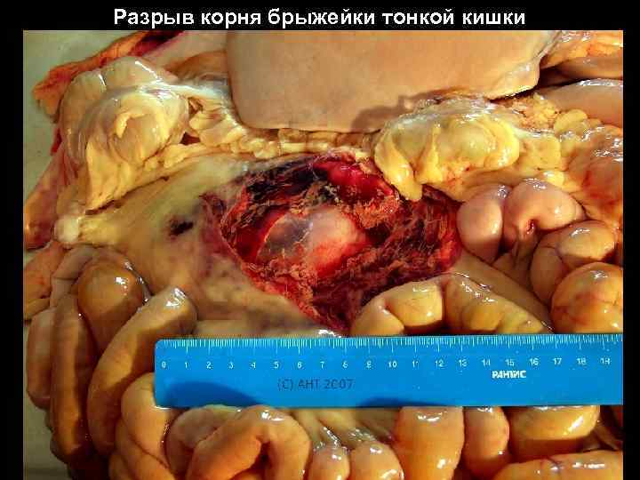 Разрыв корня брыжейки тонкой кишки 