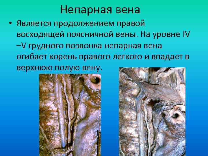 Непарная вена • Является продолжением правой восходящей поясничной вены. На уровне IV –V грудного