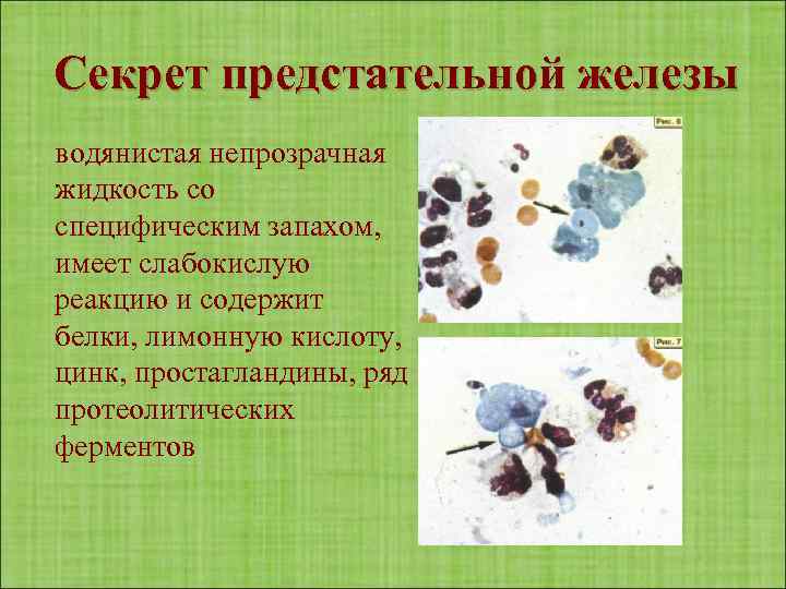 Секрет предстательной железы водянистая непрозрачная жидкость со специфическим запахом, имеет слабокислую реакцию и содержит