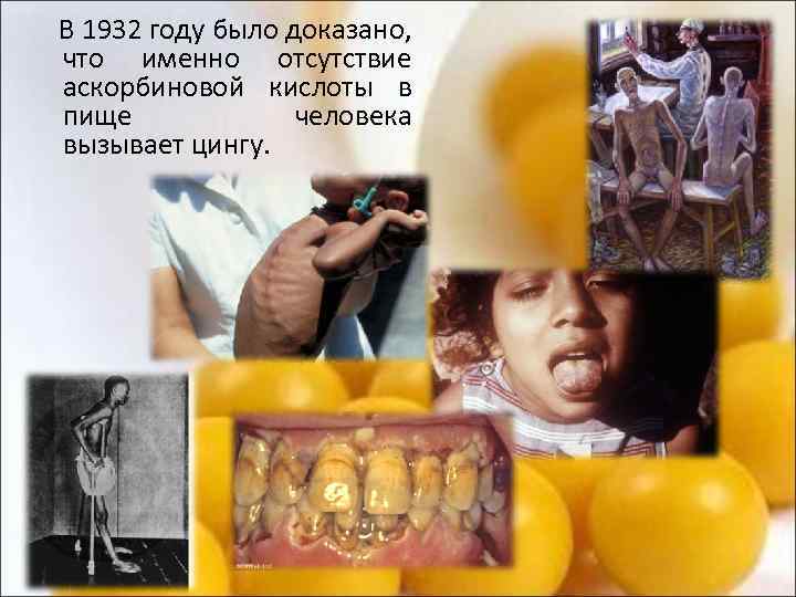  В 1932 году было доказано, что именно отсутствие аскорбиновой кислоты в пище человека