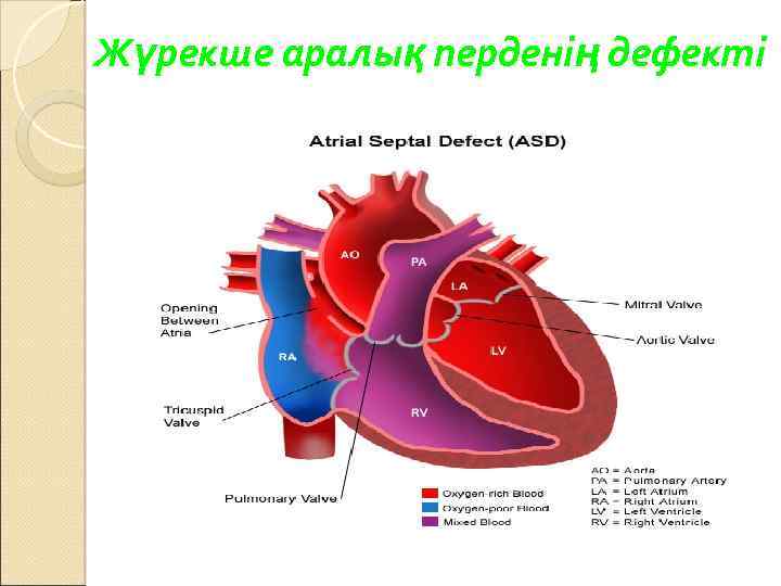 Жүрекше аралық перденің дефекті 