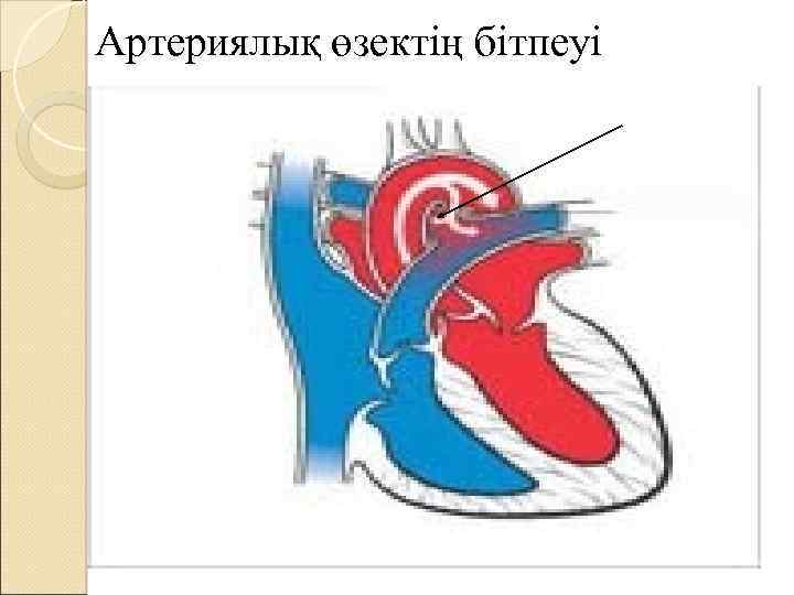 Артериялық өзектің бітпеуі 